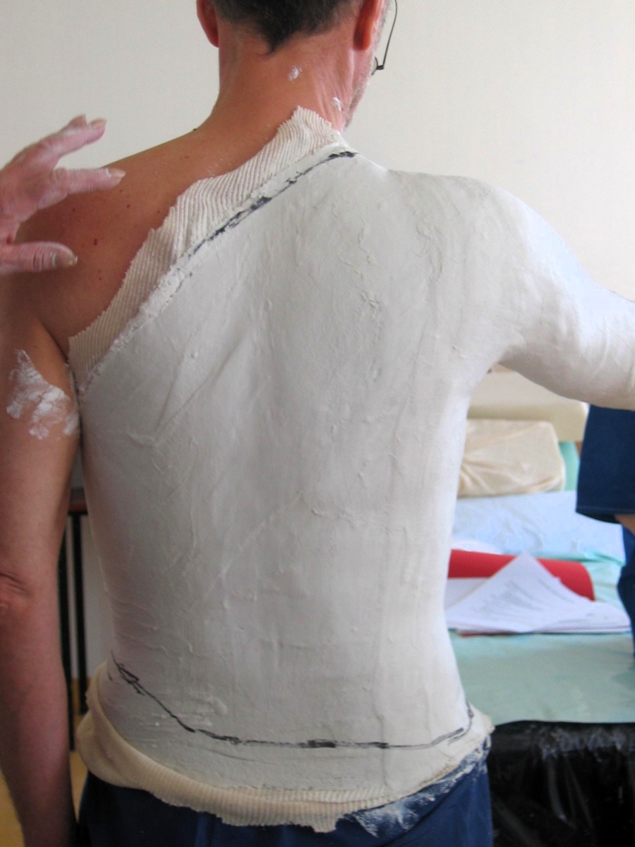 Réalisation de corsets en gypsothérapie – formation ART GYPSO